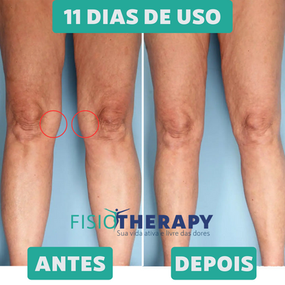 Terapia Ortopédica para Joelho