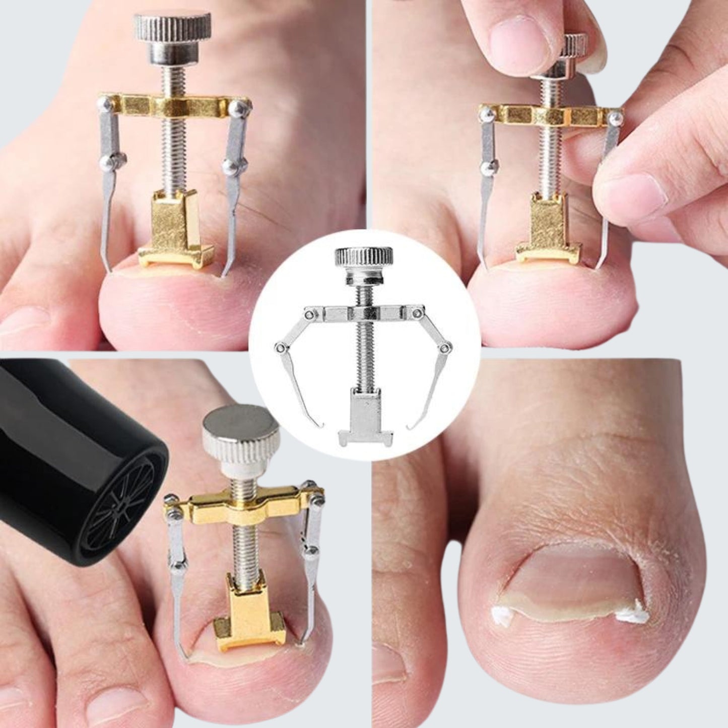 Desencravador de Unhas